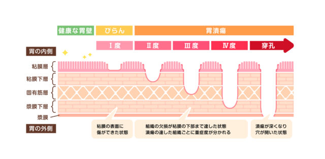 胃がんのステージ